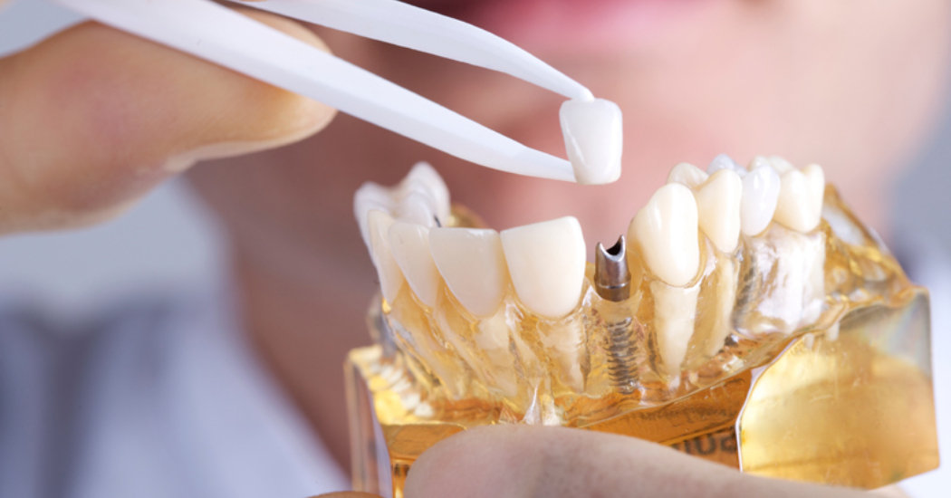 Restore Your Oral Health with Expert Root Canal in Richmond Services